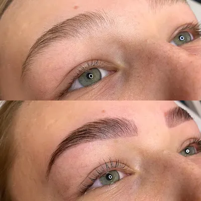 Medycyna estetyczna Gdynia - powiększanie ust - Instytut Urody Marzena Olszewska - Icoone - zabiegi laserowe